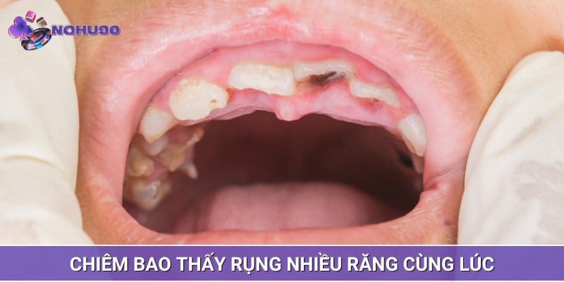 Mơ thấy rụng răng nhiều cái cùng lúc là điềm báo không tốt Mơ thấy rụng răng nhiều cái cùng lúc là điềm báo không tốt